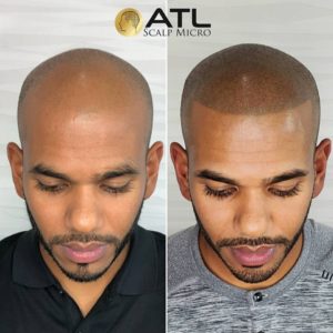 micropigmentation scalp